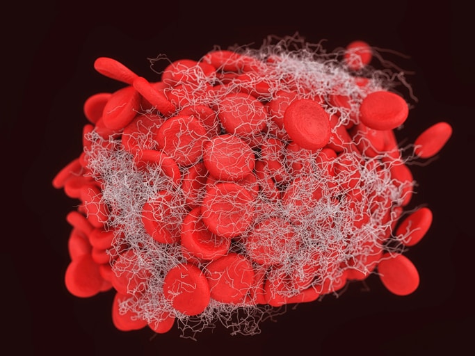 Illustration of a blood clot showing a clump of red blood cells intertwined in a fibrin mesh