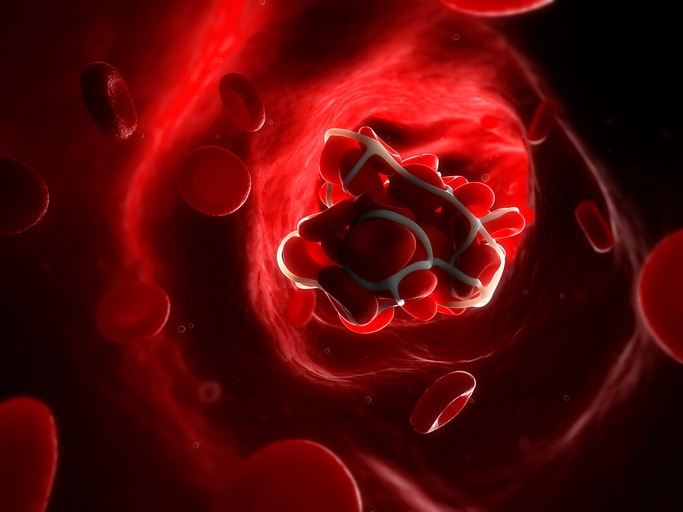Blood clot. Computer artwork of red blood cells trapped in a fibrin protein mesh in an artery.
